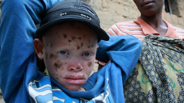 En Afrique, les albinos sont fréquemment victimes de persécutions (Photo d'illustration: IFRC/Flickr/CC BY-NC 2.0)