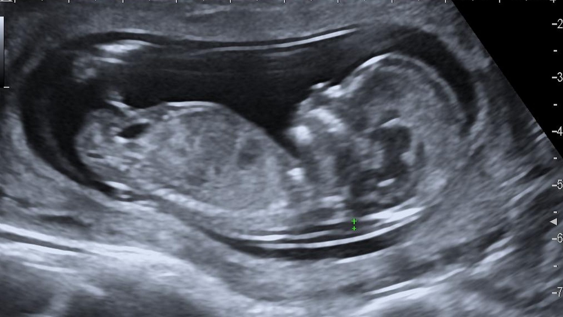 Une image par écographie d'un foetus de 12 semaines (photo DR)
