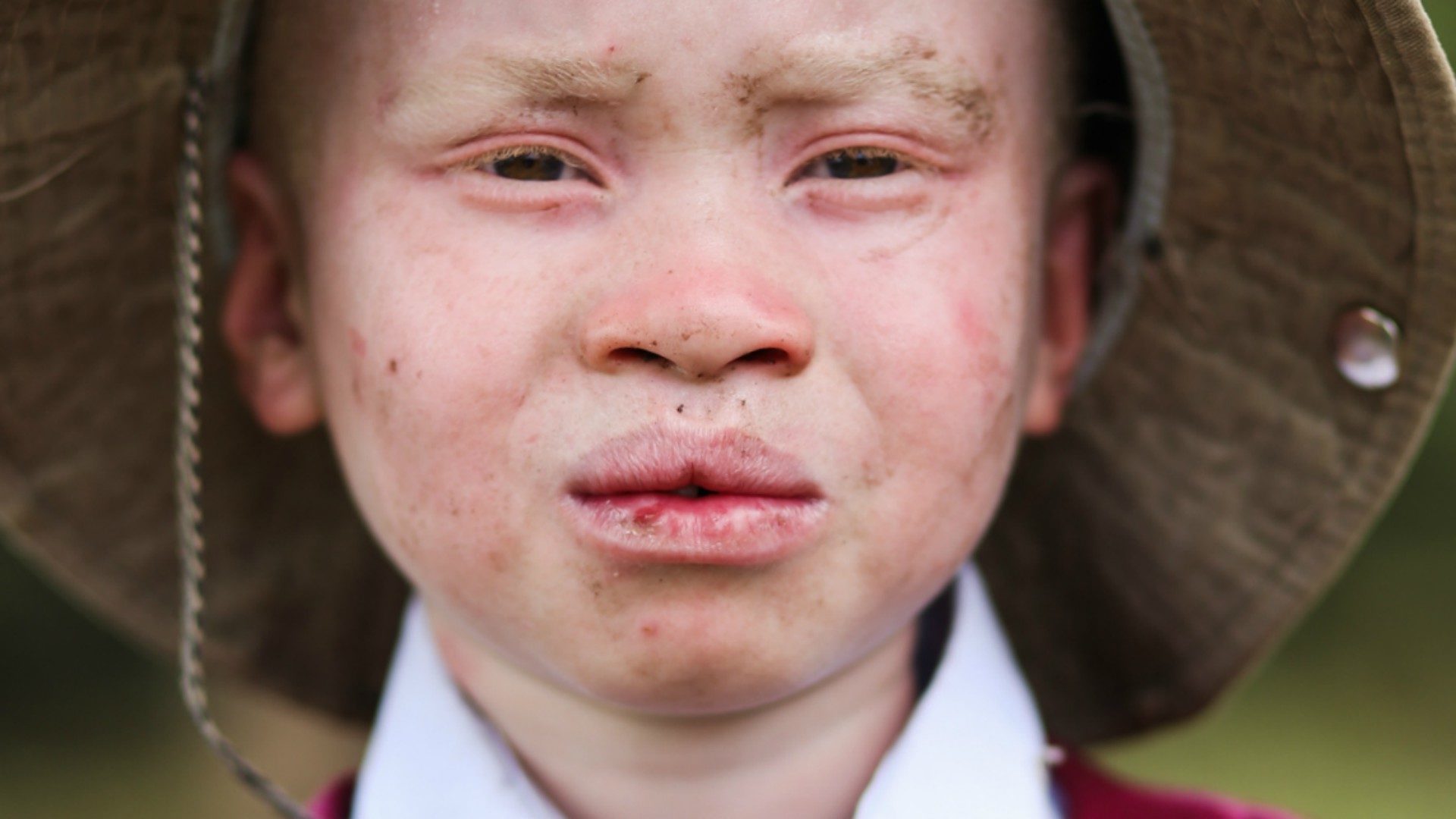 Dans certaines régions d'Afrique, les albinos subissent persécutions et attaques | © Viktor Dobai/CC BY-NC 2.0